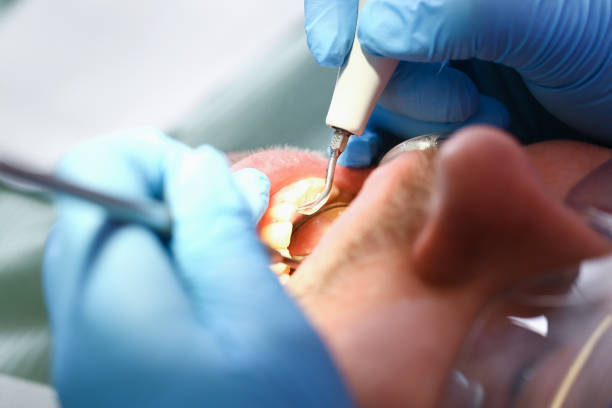 Best Emergency Treatment for Oral Infections in Bakersfield, CA