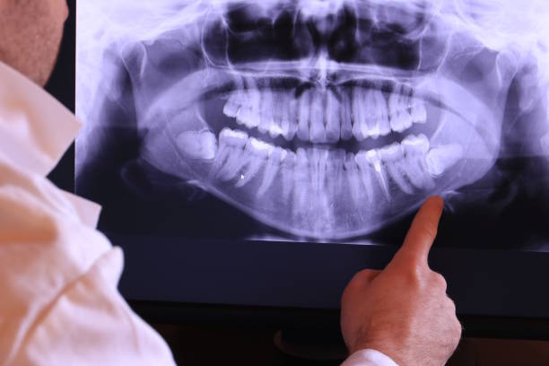 Best Emergency Wisdom Tooth Extraction in Bakersfield, CA